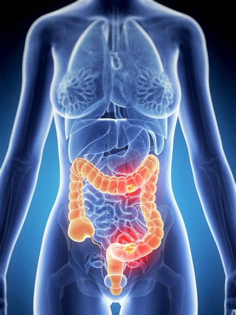 Female Colon Cancer Stock Illustration Illustration Of Organs 30727106