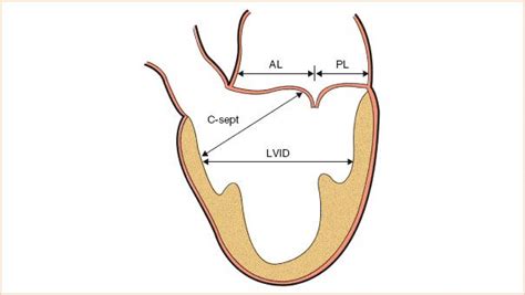 Mitral Valve Repair | Radiology Key