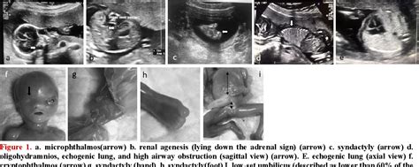 Figure 1 From A Case Of Fraser Syndrome Diagnosed By Ultrasound As A Single Modality Necessity