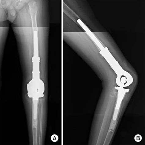 Limb Salvage Surgery Overview Janelle Wendys Blog