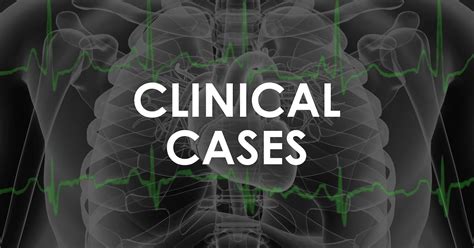 Pain Free And In Vt • Litfl • Clinical Cases Ecg Exigency