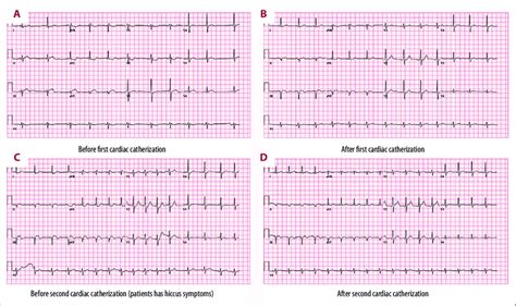 Ekg A On Admission Sinus Rhythm With Short Pr With Marked Sinus