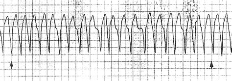 Antidromic Wpw 12 Lead Ekg