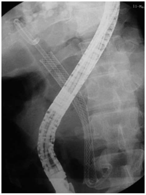 Method To Prevent Fully Covered Stent Migration Double Pigtail Plastic