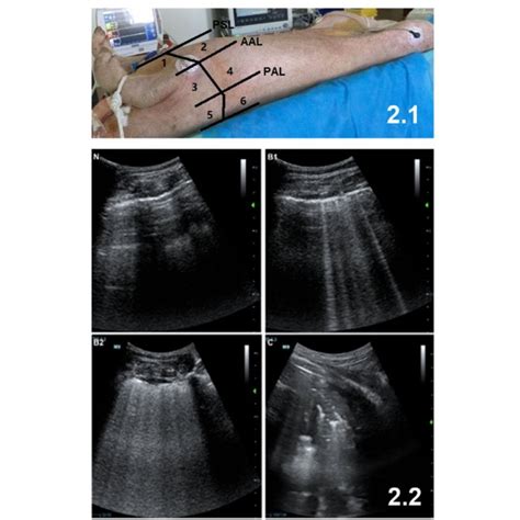 Lung Ultrasound Scanning Twelve Regions Of The Left And Right