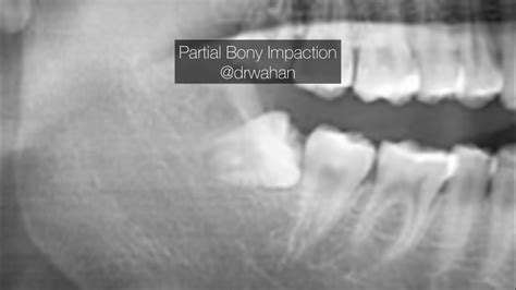 Partial Bony Wisdom Tooth Extraction Step By Step With Trough And Sectioning Youtube