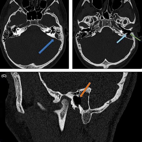 Highresolution Temporal Bone Ct Scan A Blue Arrowopacified Left