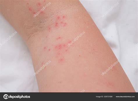 Skin Rash On Female Arm Itchy Pimples As A Result Of An Allergic Reaction Response Concept Of