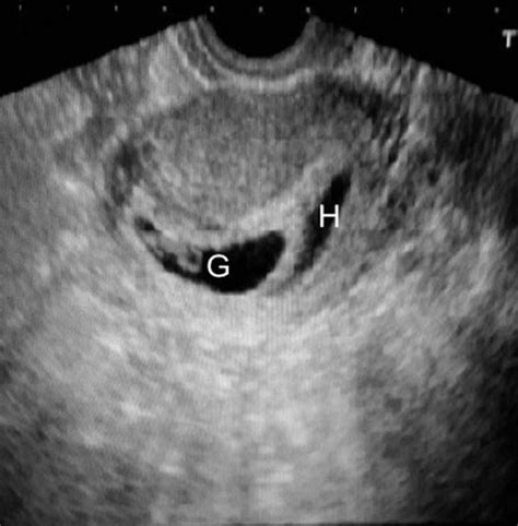 Clinical Significance Of First Trimester Intrauterine Haematomas