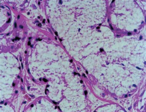 Scielo Brasil Acinar Autolysis And Mucous Extravasation In Human