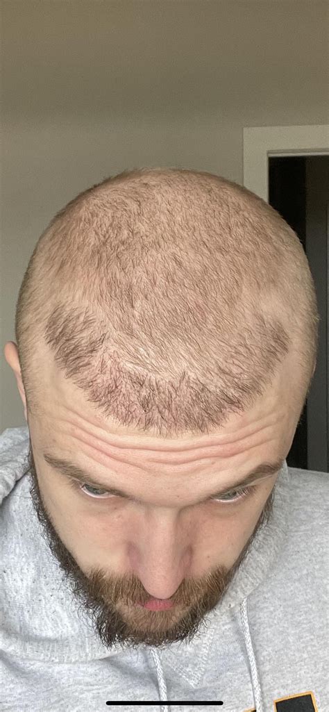 Bad Hair Transplant Need Advice Please Rhairtransplants