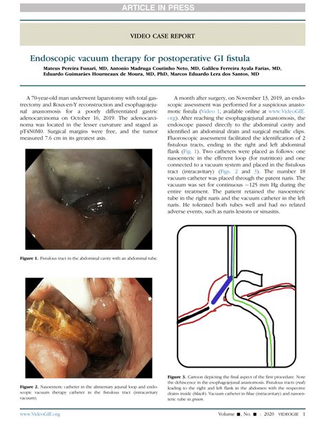 PDF Endoscopic Vacuum Therapy For Postoperative GI Fistula