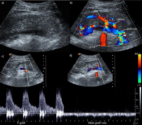 A Longitudinal Conventional B Mode Ultrasound Demonstrating The Usual