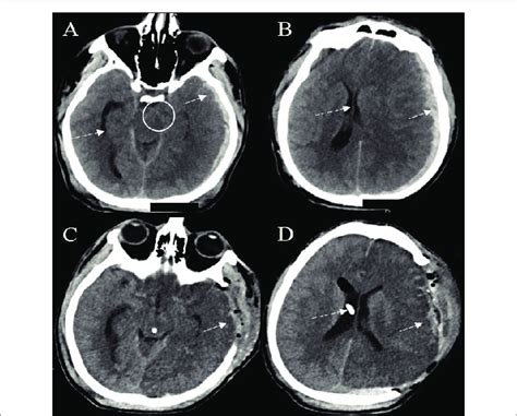 Computed Tomography CT Of The Head CT Scan Showed A Left Hemispheric