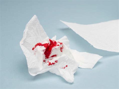 How are bleeding hemorrhoids treated at home? - Doctor Omar Chughtai