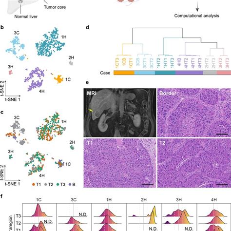 Multiregional Single Cell Transcriptome Profiling Of Liver Cancer A