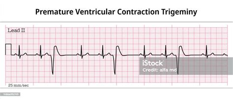 Premature Ventricular Contraction Trigeminy