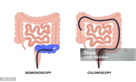 Kolonoskopi Dan Sigmoidoskopi Ilustrasi Stok Unduh Gambar Sekarang
