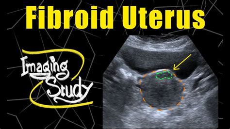 Uterine Fibroids Ultrasound