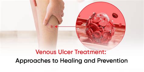 Venous Ulcer Treatment Approaches To Healing And Prevention Laser