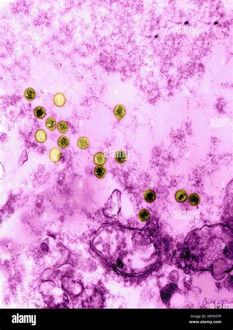 Transmission Electron Micrograph Tem Revealing The Presence Of Numerous Epstein Barr Virus