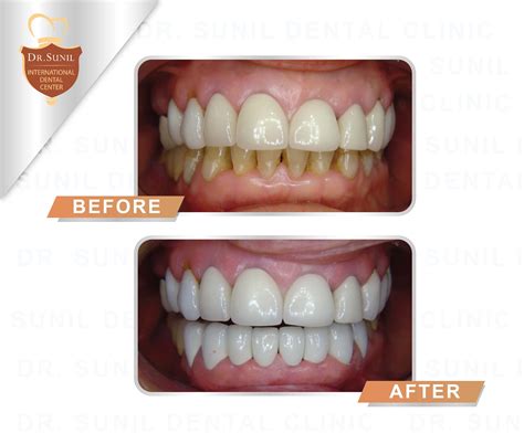 porcelain veneers bangkok save     treatment
