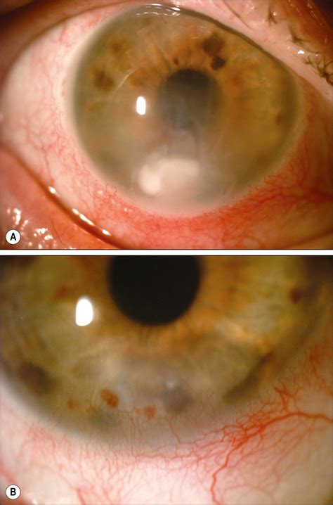 Collagen Crosslinking For Infectious Keratitis Clinical Tree