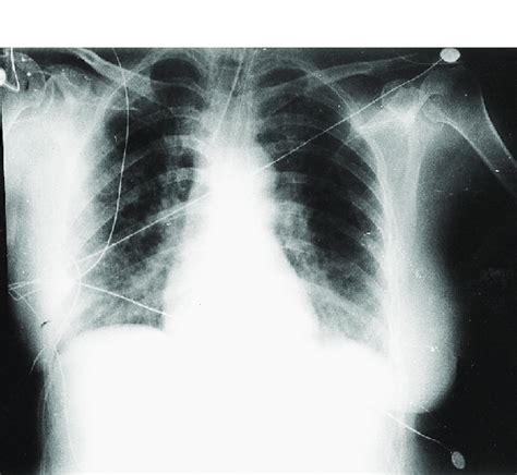 The Anteroposterior Radiograph Of The Patient S Chest Shows The