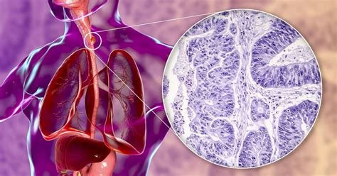 8 Esophageal Cancer Risk Factors - Birmingham Gastroenterology Associates