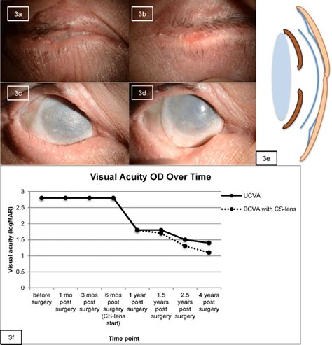 The Pre And Postoperative Ophthalmological Findings In Case 3 Images