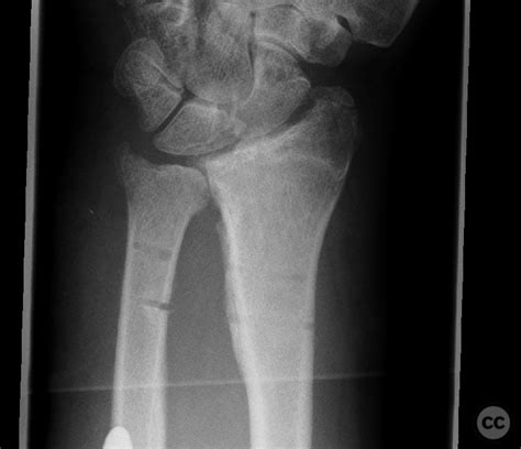 Essex Lopresti Fracture Dislocation