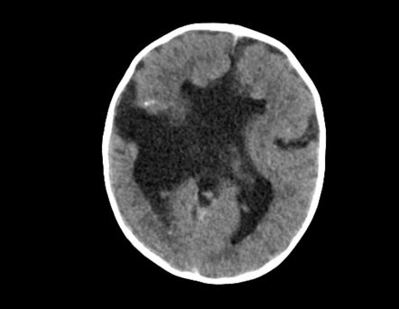 Schizencephaly Bilateral Open Lip Radiology Case Radiopaedia Org