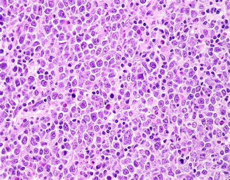 Diffuse Large B Cell Lymphoma Photograph By Webpathology Science Photo