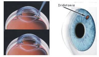 Alta Visión Iridotomía