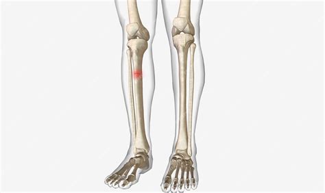 Premium Photo | A fracture is an acute injury that causes a partial or ...