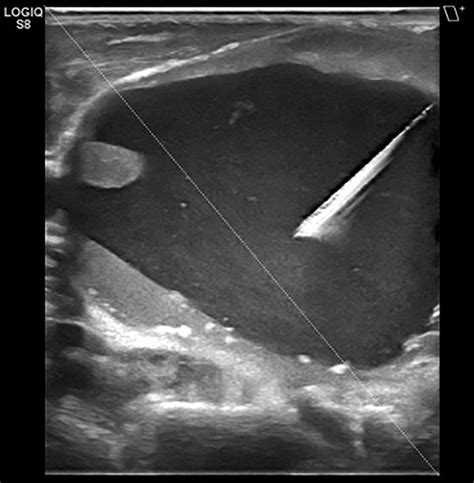 Treatment Of Cystic Thyroid Nodules Techniques In Vascular