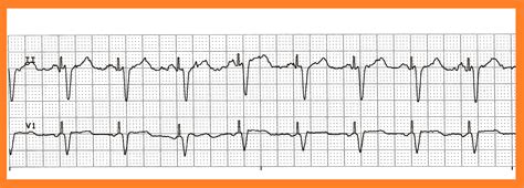 Various Ventricular Paced Rhythms