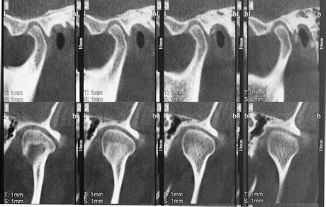 Case 3 Preoperative Cone Beam Computed Tomograms Of Temporomandibular Download Scientific