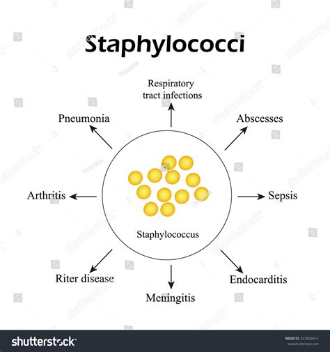 Staphylococci Staphylococcus Aureus Causes Diseases Infographics Stock ...