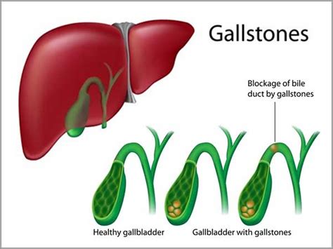 Gallbladder Disorders Symptoms Diagnosis Gallstone Pancreatitis