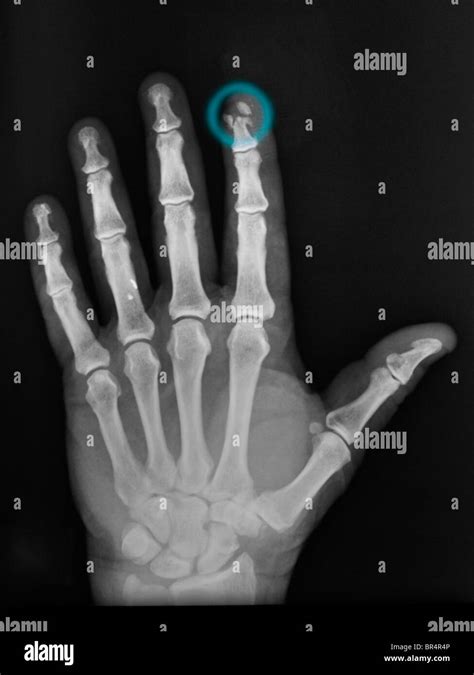 Broken Hand X Ray High Resolution Stock Photography and Images - Alamy