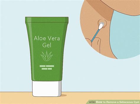 The Gentle Art Of Healing: 5 Simple Remedies To Dissolve Cysts At Home