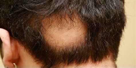 Farmácia De Manipulação Cavalieri Alopecia • Farmácia De Manipulação Cavalieri