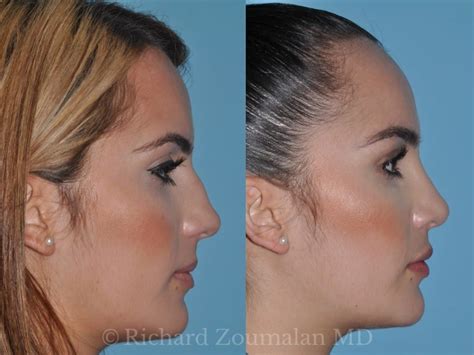 Rhinoplasty In Los Angeles Nose Surgery Beverly Hills Dr Zoumalan