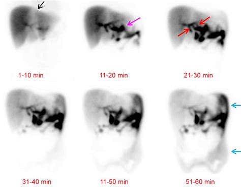 Abnormal Gallbladder Hida Scan Results