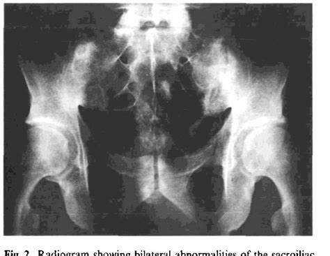 Figure 2 From Renal Involvement In Ankylosing Spondylitis Bechterew S