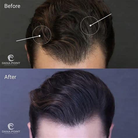 Hair Loss (Men) - Before and After | Dana Point Dermatology