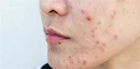 Cystic Acne Symptoms Causes And Treatment Options