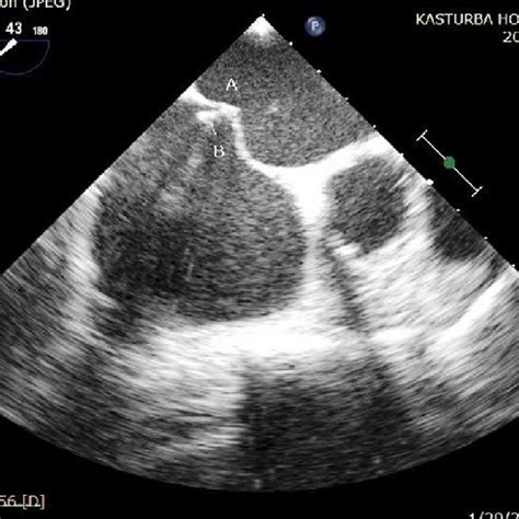 Transesophageal Echocardiography Guided Transseptal Puncture Which Is