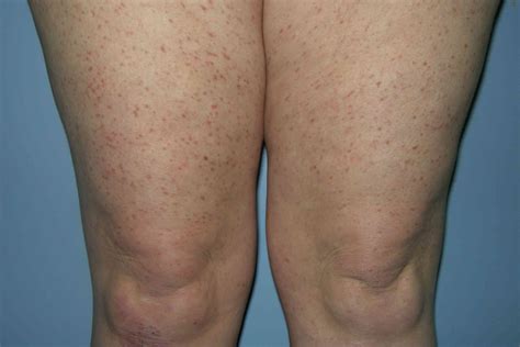 Urticaria Pigmentosa Lesions Mastocytosis Treatment